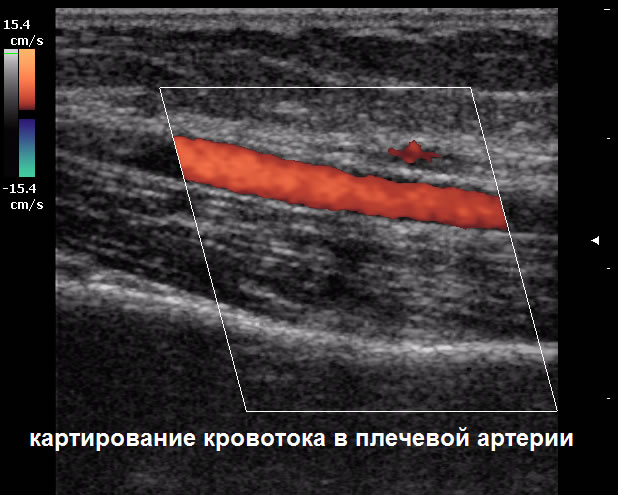 УЗД у Полтаві - картування кровотоку в плечовій артерії